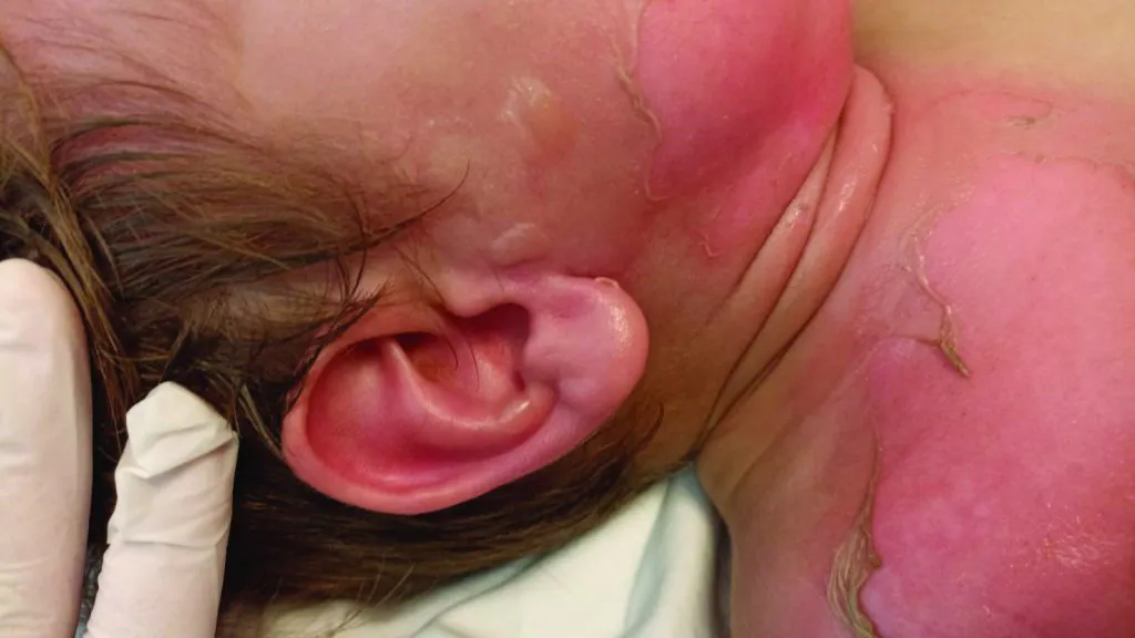 Bebe Quemada Foto Referencial 